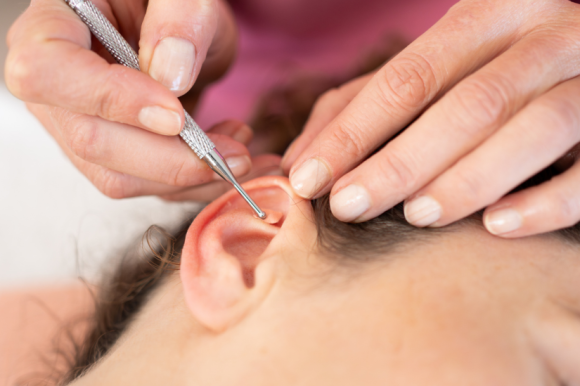 Auriculoterapia